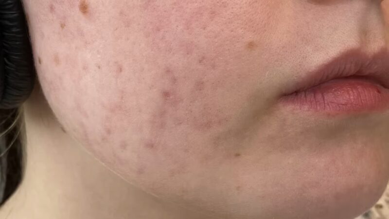 Why Digestion Issues Cause Acne