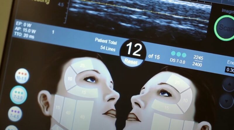 Monitor showing human's face during Ultherapy